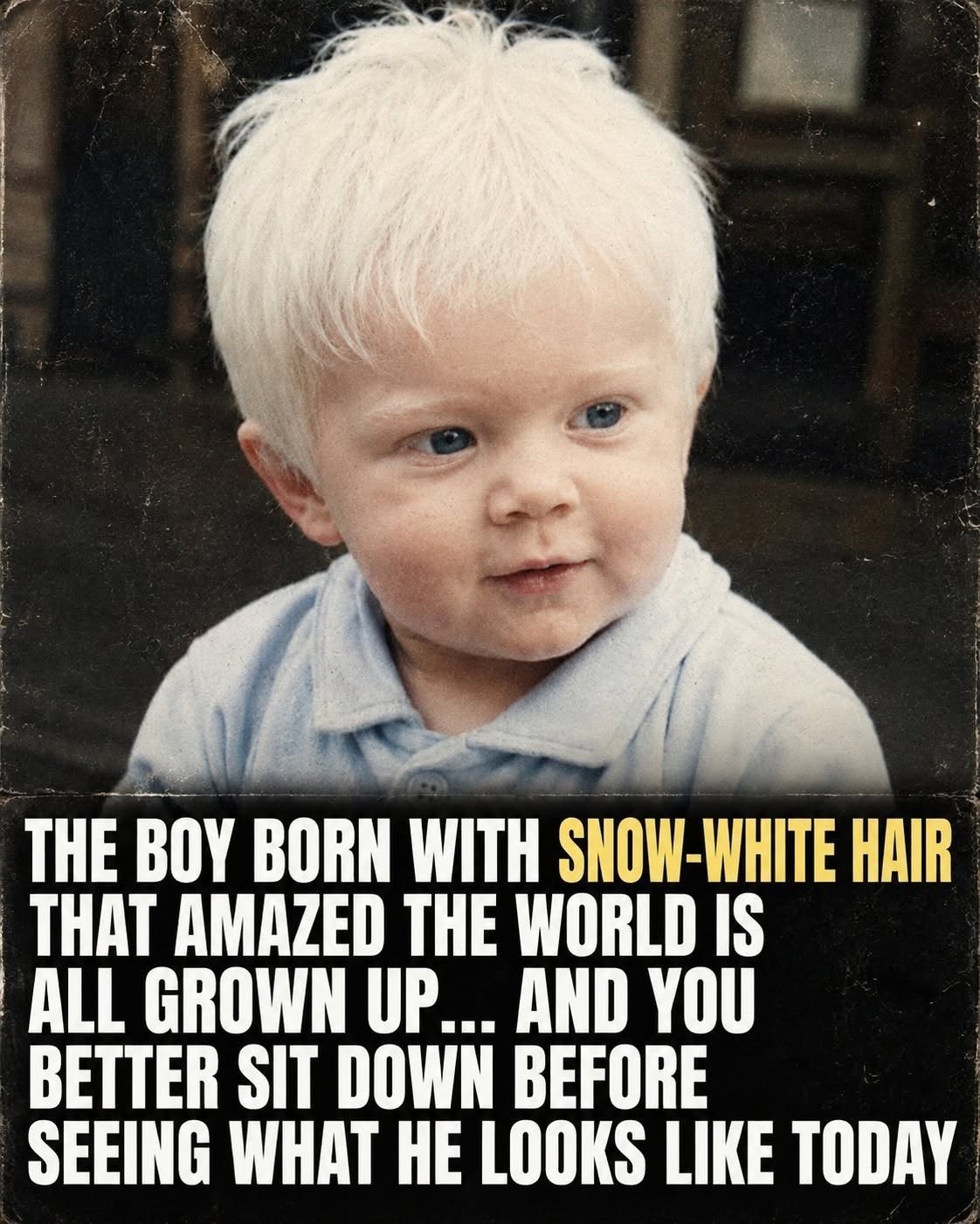 The Boy Born With Snow-White Hair – His Life Today